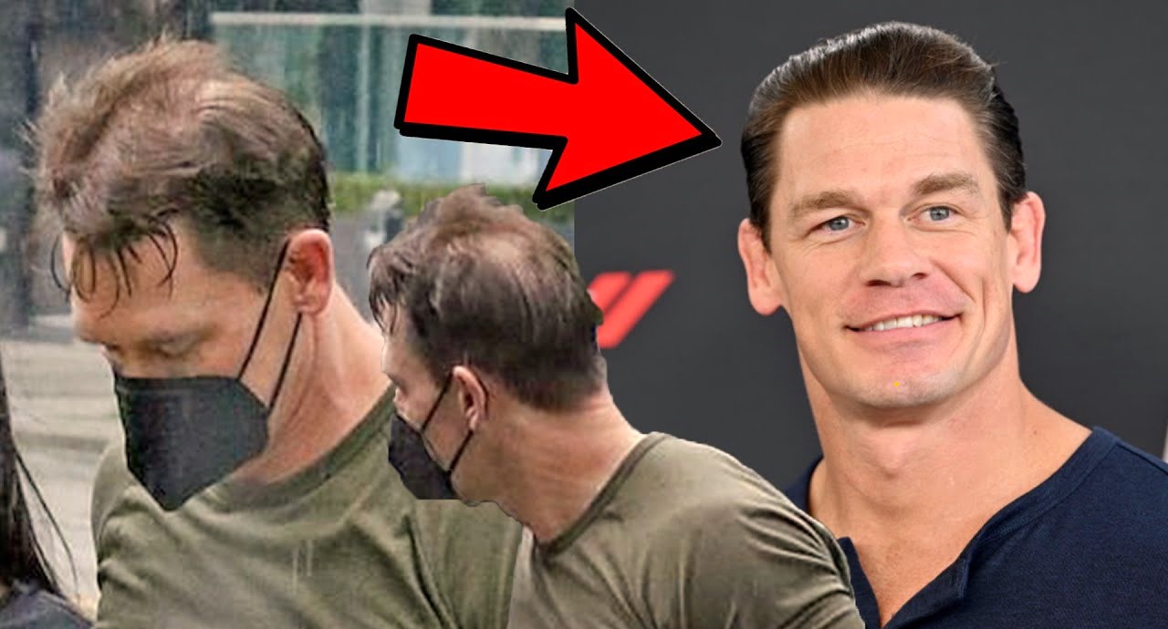 How John Cena Overcame Hair Loss with a Successful Hair Transplant