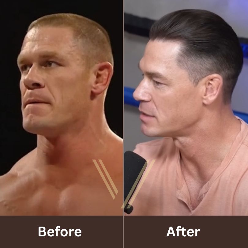 How John Cena Overcame Hair Loss with a Successful Hair Transplant
