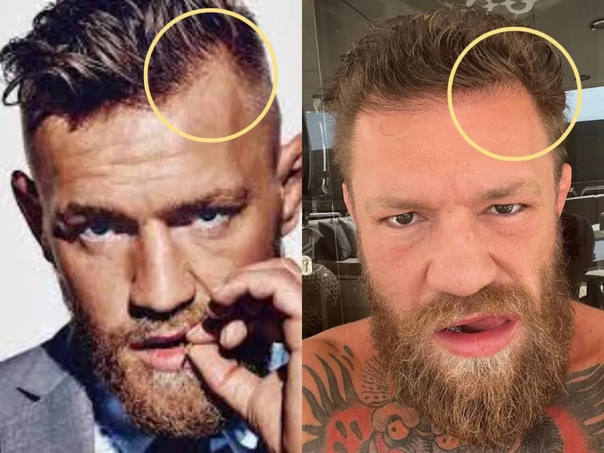 Did Conor McGregor fix his hairline? Examining the Conor McGregor hairline transformation evidence.